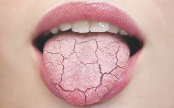 What foods help with dry mouth